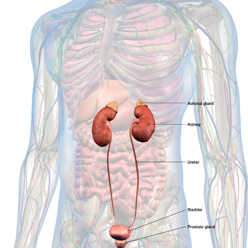 kidney stone