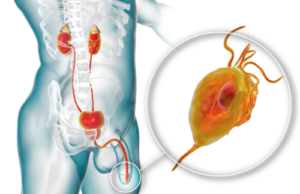 Transurethral Resection